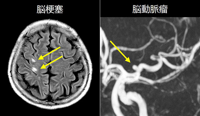 脳梗塞・脳動脈瘤